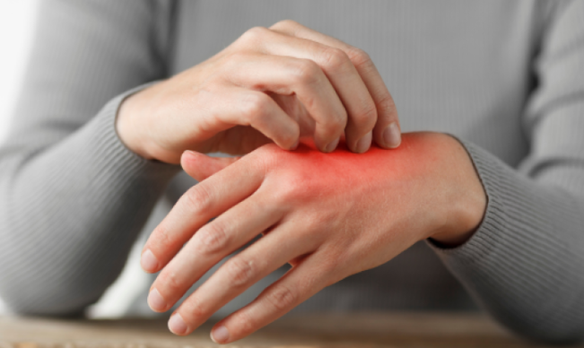 Shenjat që tregojnë se ekzema juaj është e rëndë