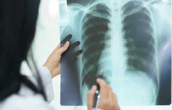 MSH: 548 raste të reja me tuberkuloz në Kosovë gjatë vitit 2024