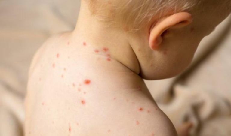 Shqipëri: 18 raste me fruth, shumica e fëmijëve të pavaksinuar