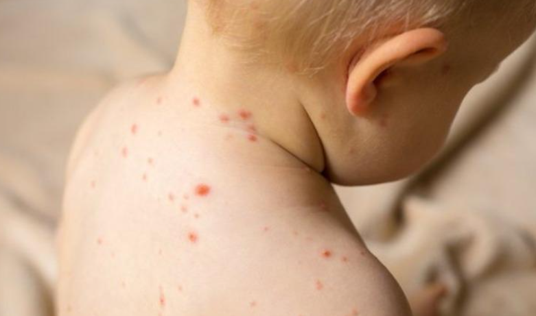 Shqipëri: 18 raste me fruth, shumica e fëmijëve të pavaksinuar