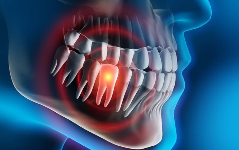 9 mënyra efektive për të lehtësuar dhimbjen e dhëmbit gjatë natës