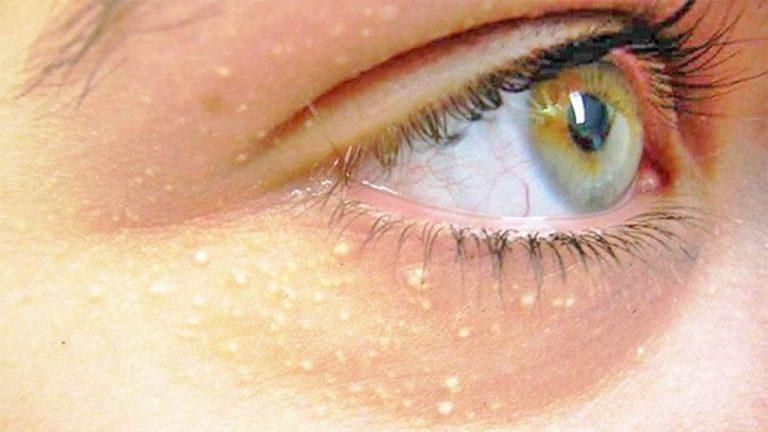 ✨👀 Pikat e bardha rreth syve: Çfarë tregojnë dhe si t’i trajtoni natyralisht 🧴🥕