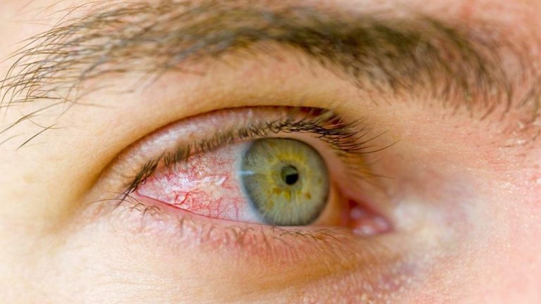 👀 Ushqimet dhe Këshillat Natyrale për Sy të Shëndetshëm
